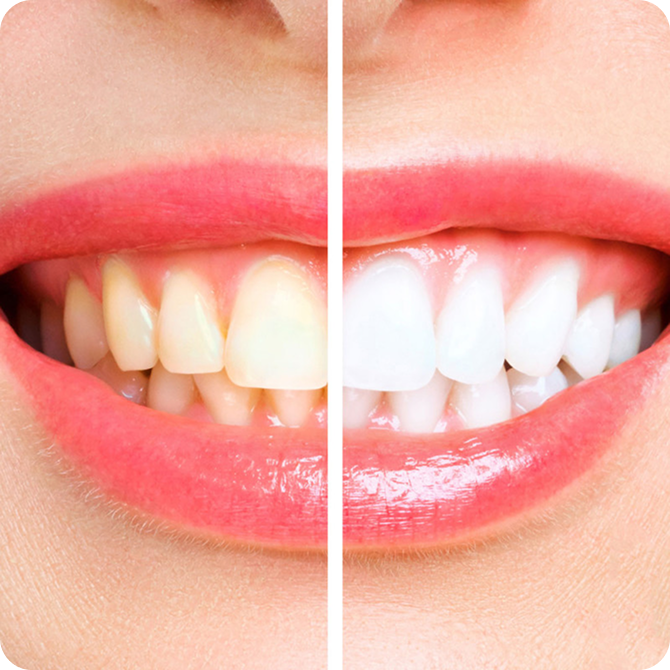 Anterior Veneer Rehabilitation - Before