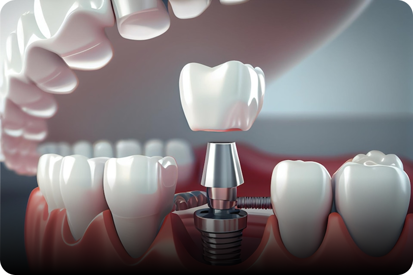 Dental Implants & Oral Surgery