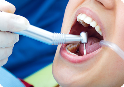 Preventive fluoride and fissure sealant treatment